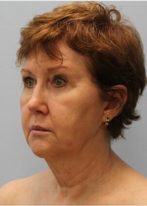 Before Image: Facelift – Dr. Howell - left-front-oblique