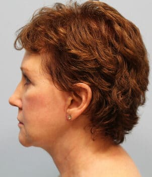 After Image: Facelift – Dr. Howell - left-side