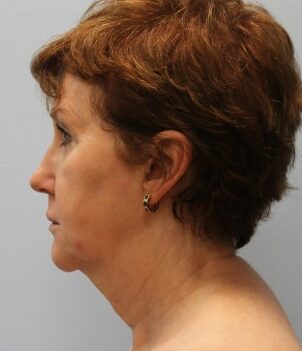 Before Image: Facelift – Dr. Howell - left-side