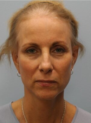 After Image: Facelift – Dr. Howell - front