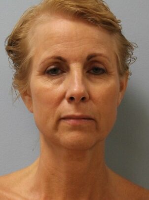 Before Image: Facelift – Dr. Howell - front