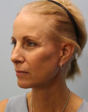 After Image: Facelift – Dr. Howell - left-front-oblique