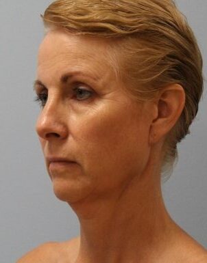 Before Image: Facelift – Dr. Howell - left-front-oblique