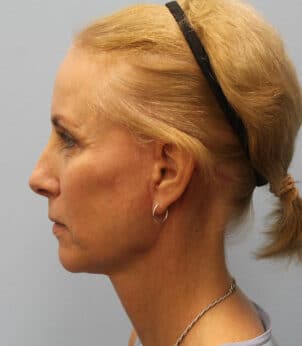 After Image: Facelift – Dr. Howell - left-side