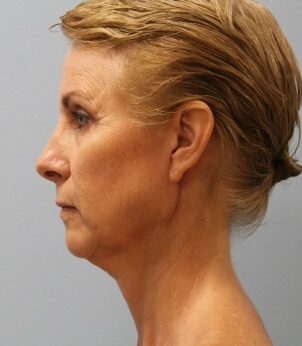 Before Image: Facelift – Dr. Howell - left-side