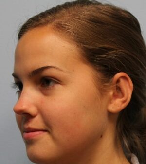 After Image: Otoplasty  – Dr. Howell - left-front-oblique