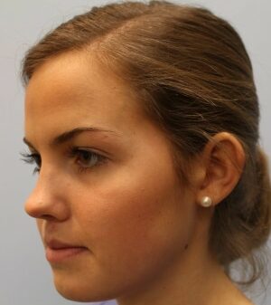 Before Image: Otoplasty  – Dr. Howell - left-front-oblique