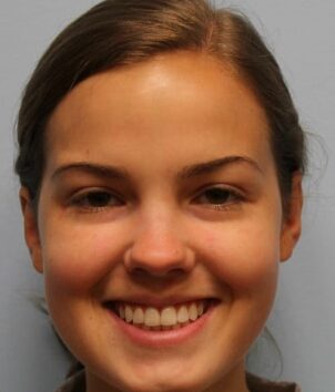 After Image: Otoplasty  – Dr. Howell - front