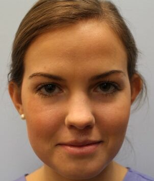 Before Image: Otoplasty  – Dr. Howell - front