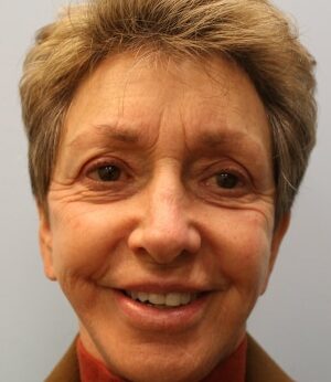 After Image: Otoplasty – Dr. Howell - front