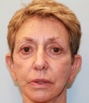Before Image: Otoplasty – Dr. Howell - front