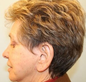 After Image: Otoplasty – Dr. Howell - left-side