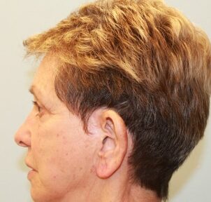 Before Image: Otoplasty – Dr. Howell - left-side