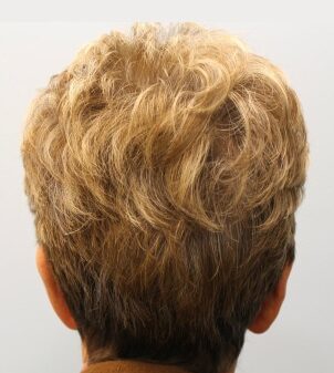 After Image: Otoplasty – Dr. Howell - back