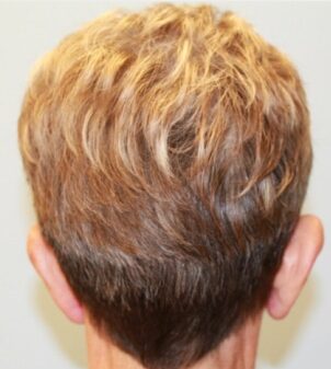 Before Image: Otoplasty – Dr. Howell - back