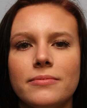 After Image: Rhinoplasty (nose reshaping) – Dr. Howell - front