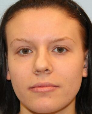 Before Image: Rhinoplasty (nose reshaping) – Dr. Howell - front