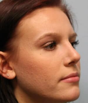 After Image: Rhinoplasty (nose reshaping) – Dr. Howell - right-front-oblique