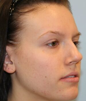 Before Image: Rhinoplasty (nose reshaping) – Dr. Howell - right-front-oblique