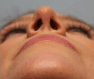 After Image: Rhinoplasty (nose reshaping) – Dr. Howell - front