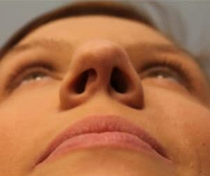 Before Image: Rhinoplasty (nose reshaping) – Dr. Howell - front