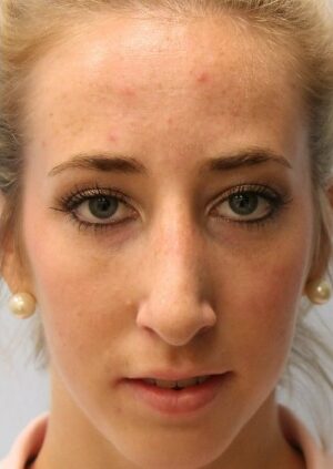 After Image: Rhinoplasty – Dr. Tucker - front