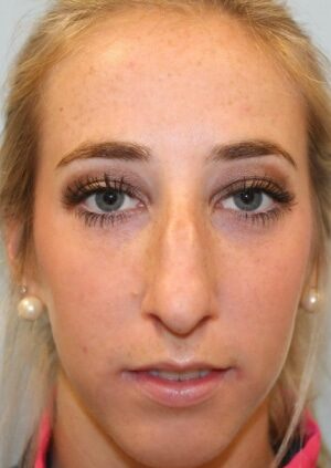 Before Image: Rhinoplasty – Dr. Tucker - front