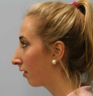 After Image: Rhinoplasty – Dr. Tucker - left-side