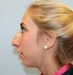 Before Image: Rhinoplasty – Dr. Tucker - left-side