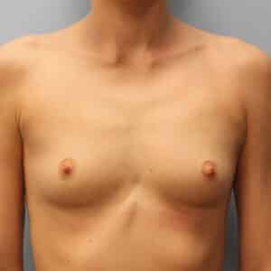 Breast Augmentation – Dr. Howell