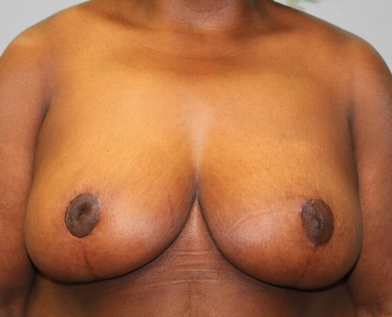 After Image: Breast Reduction – Dr. Howell - front
