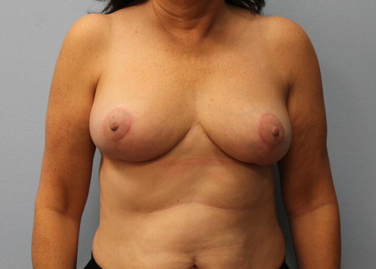 After Image: Breast Reduction – Dr. Howell - front
