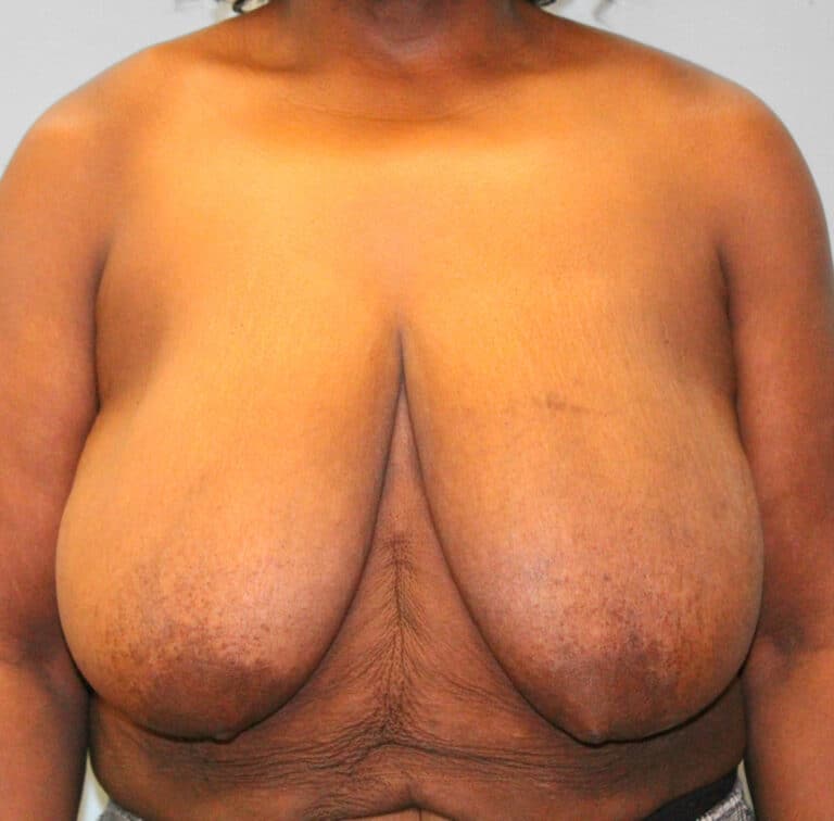 Before Image: Breast Reduction – Dr. Howell - front