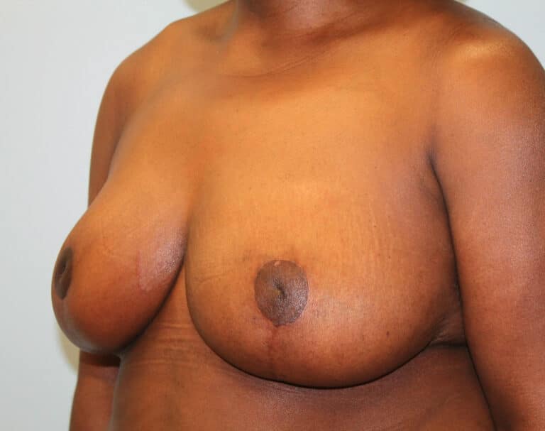 After Image: Breast Reduction – Dr. Howell -