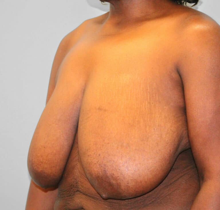 Before Image: Breast Reduction – Dr. Howell -