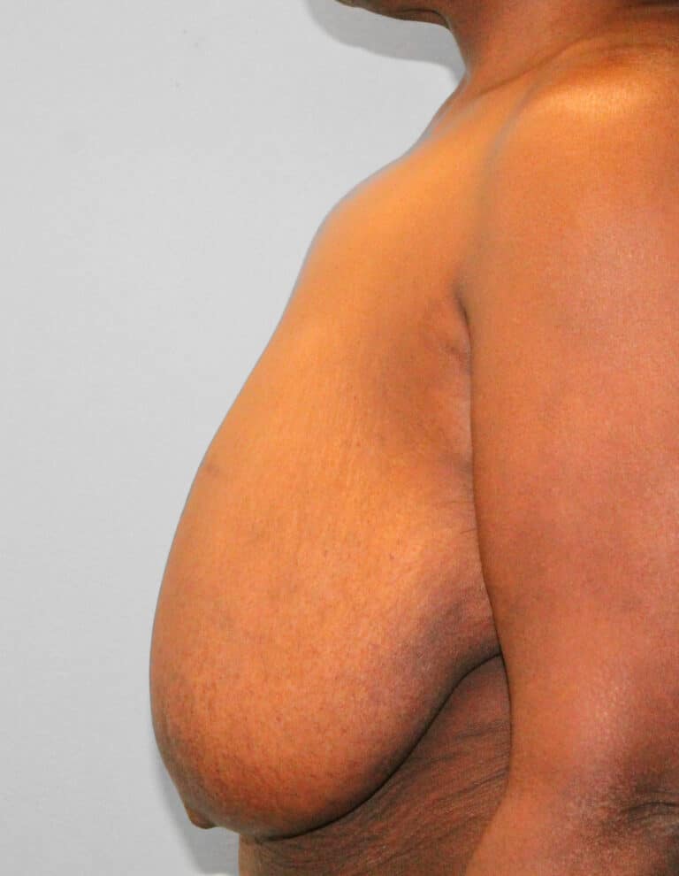 Before Image: Breast Reduction – Dr. Howell -