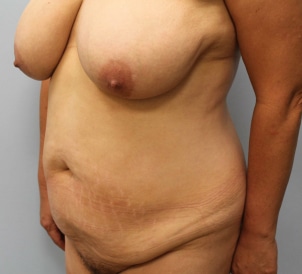 Before Image: Mommy Makeover – Dr. Howell - other