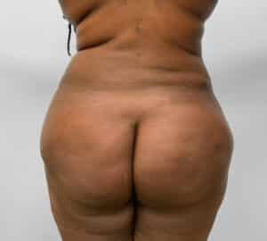 BBL Fat Transfer- Dr. Tucker