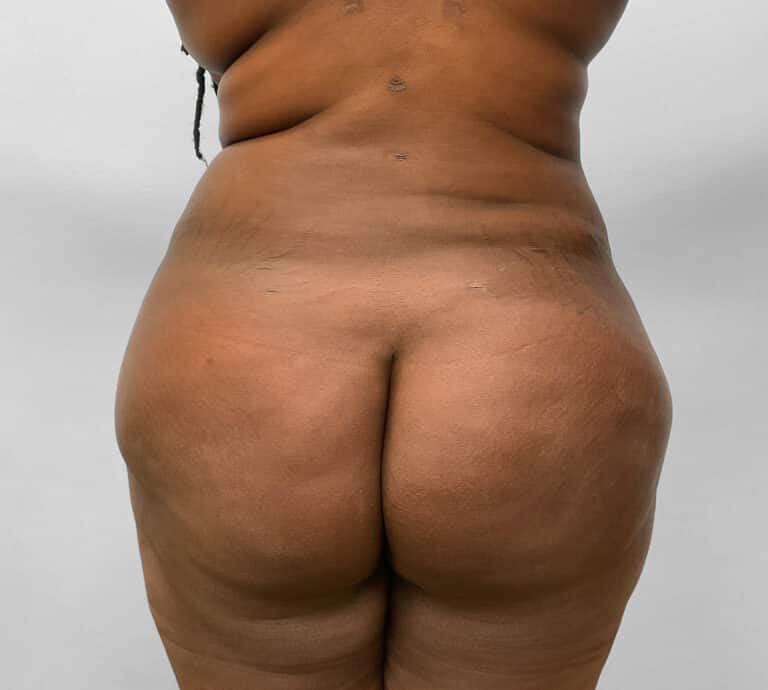 After Image: BBL Fat Transfer- Dr. Tucker - back