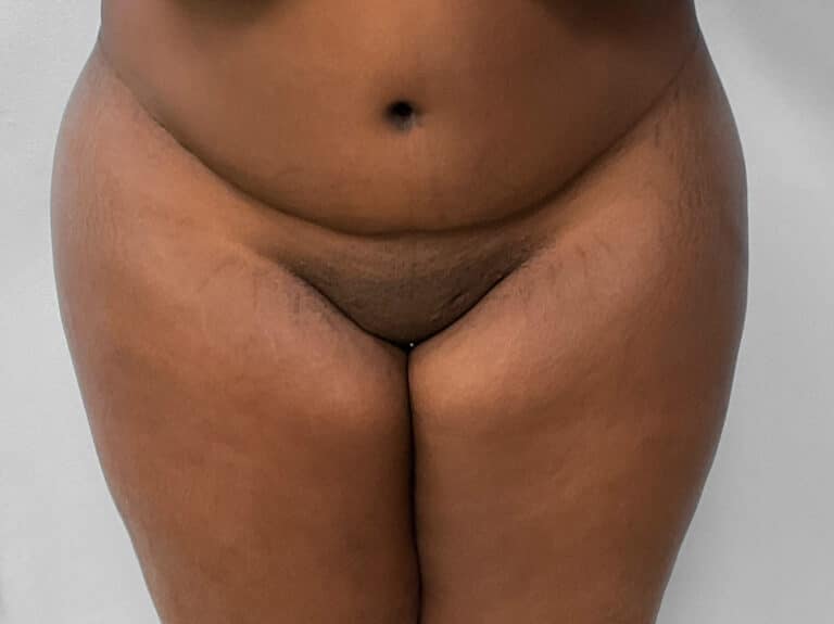 After Image: BBL Fat Transfer- Dr. Tucker - front
