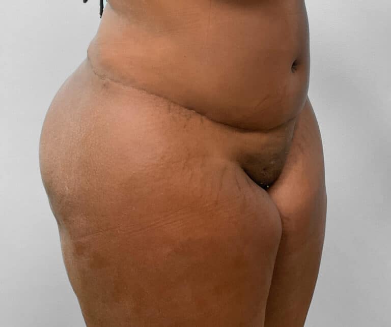 After Image: BBL Fat Transfer- Dr. Tucker - right-front-oblique