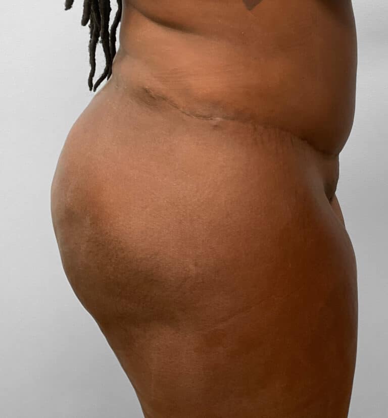 After Image: BBL Fat Transfer- Dr. Tucker - right-side