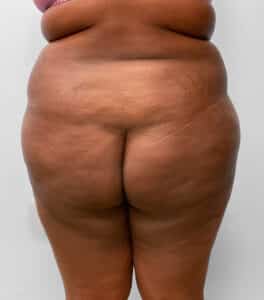BBL Fat Transfer- Dr. Tucker