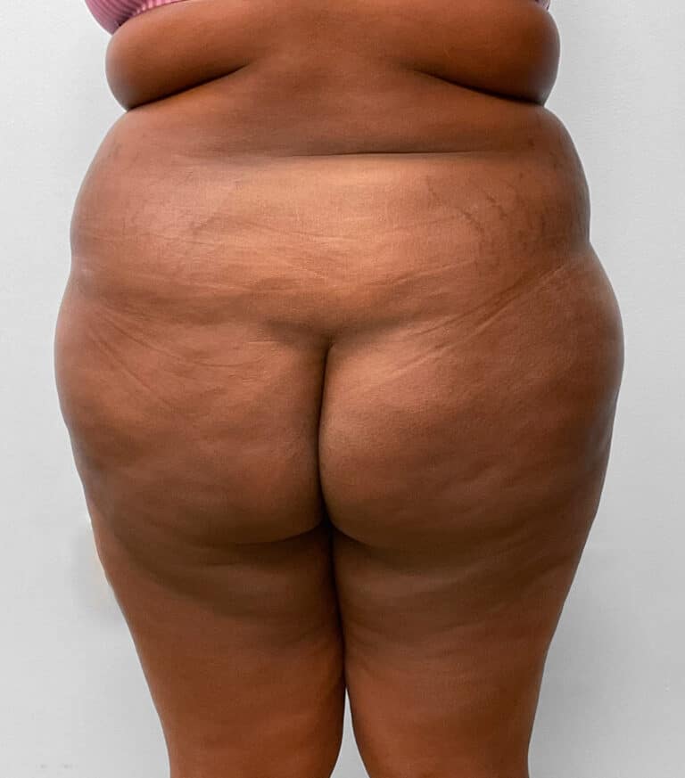 Before Image: BBL Fat Transfer- Dr. Tucker - back