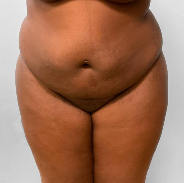 Before Image: BBL Fat Transfer- Dr. Tucker - front