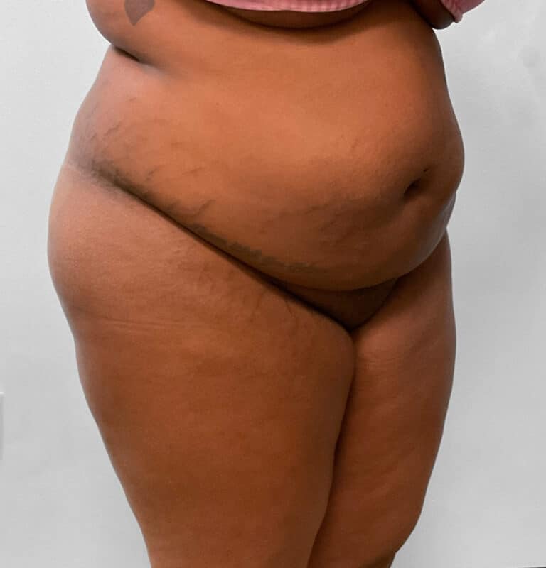 Before Image: BBL Fat Transfer- Dr. Tucker - right-front-oblique