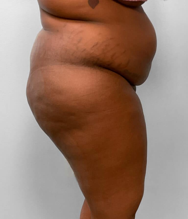 Before Image: BBL Fat Transfer- Dr. Tucker - right-side
