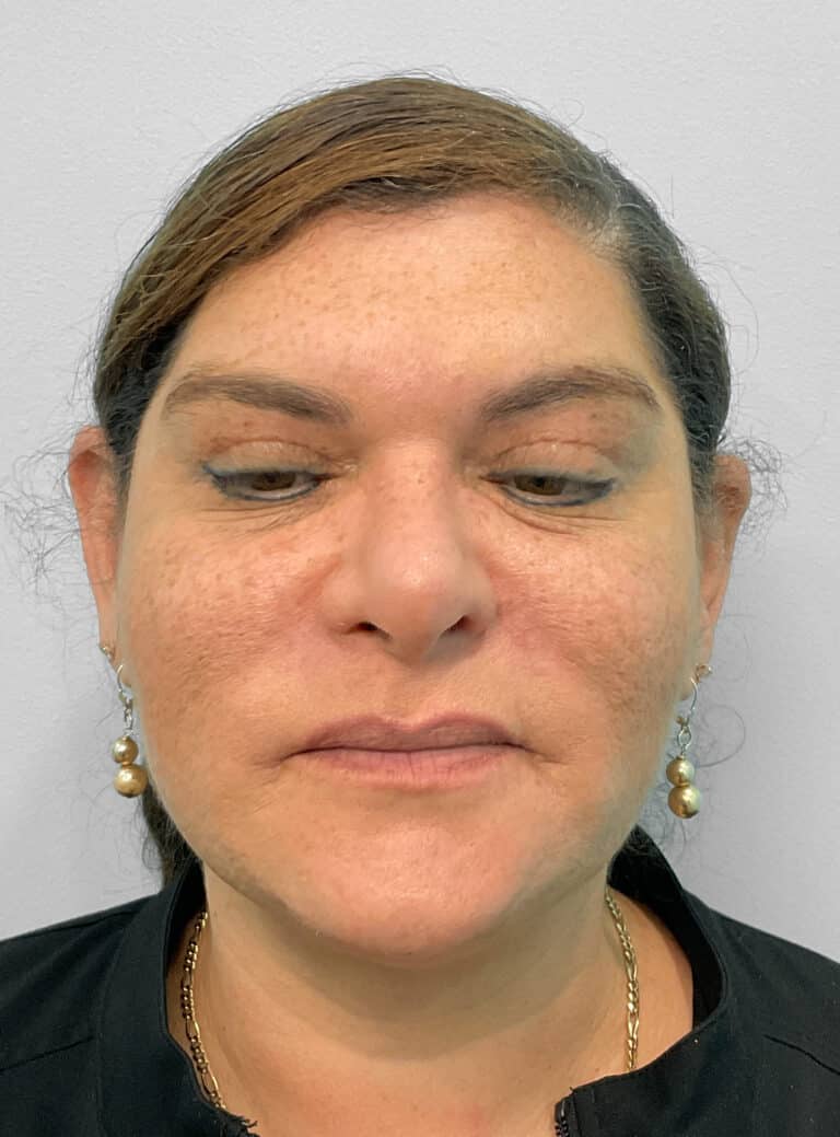 After Image: Kybella- Joy - front