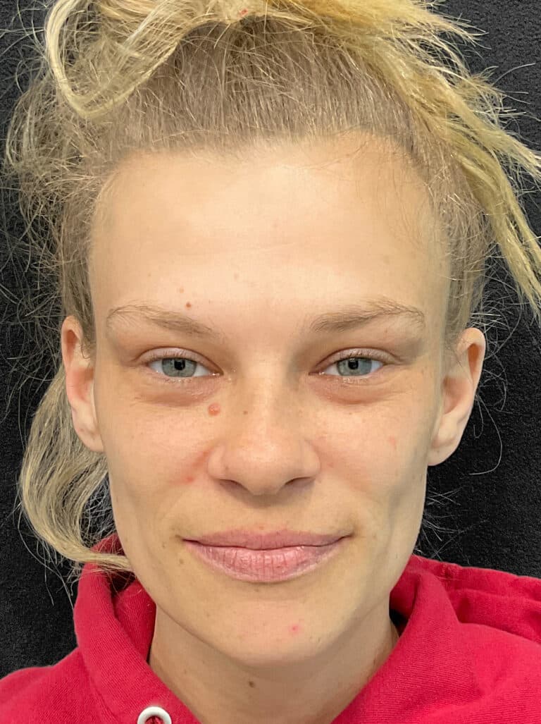 After Image: Botox- Joy - front