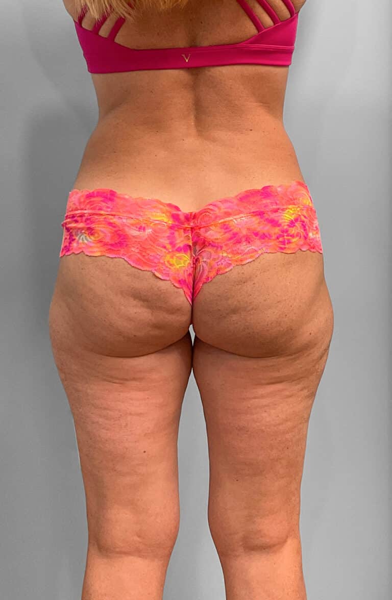 After Image: Emsculpt Neo- Jessica - back